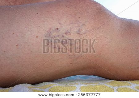 Mature Female Leg Varicose Veins  Close Up