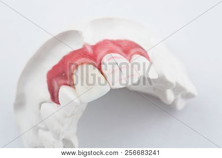 Wax Pattern Teeth Dental Crowns On Model, Metal Free - Front View .ceramic Front Veneers Isolated On