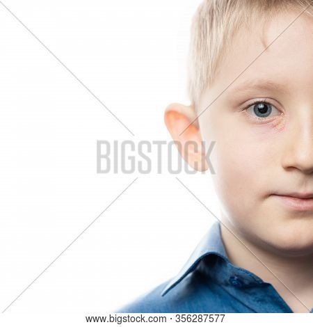 Herpes Is An Eye Disease On The Face Of A Child. Little Boy With Conjunctivitis. Rash Near The Eye. 