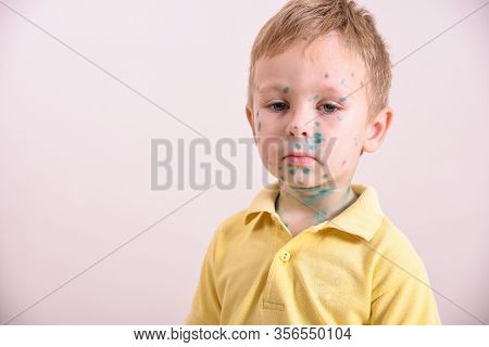 Young Toddler,boy With Chickenpox. Sick Child With Chickenpox. Varicella Virus Or Chickenpox Bubble