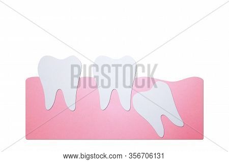 Wisdom Tooth ( Angular Or Mesial Impaction ) Affect To Other Teeth - Dental Cartoon Paper Cut Style 