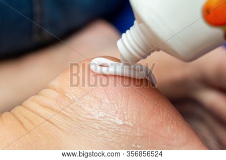 Applying Cream From The Tube On The Feet Sole For The Treatment Of Corn, Callus, Callosity, Cracks, 