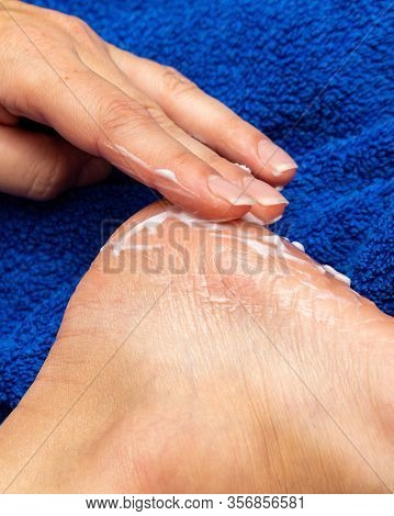 Applying Cream From The Tube On The Feet Sole For The Treatment Of Corn, Callus, Callosity, Cracks, 