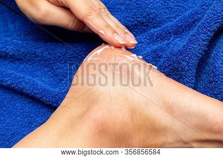 Applying Cream On The Feet Sole For The Treatment Of Corn, Callus, Callosity, Cracks, Softening The