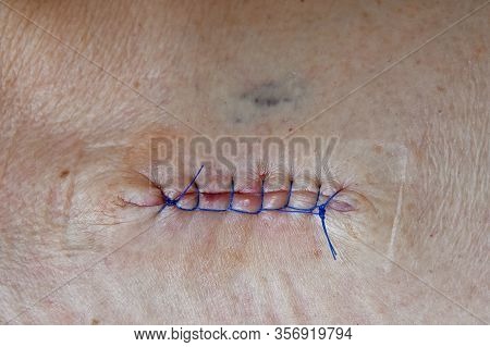 A Pre-cancerous Growth Is Removed From A Leg With Suture Closing The Wound.
