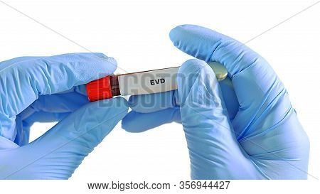 Hands In Gloves, Keep Medical Tube With Venous Blood. Use Your Thumb To Hold Shortcut Evd. Isolated 