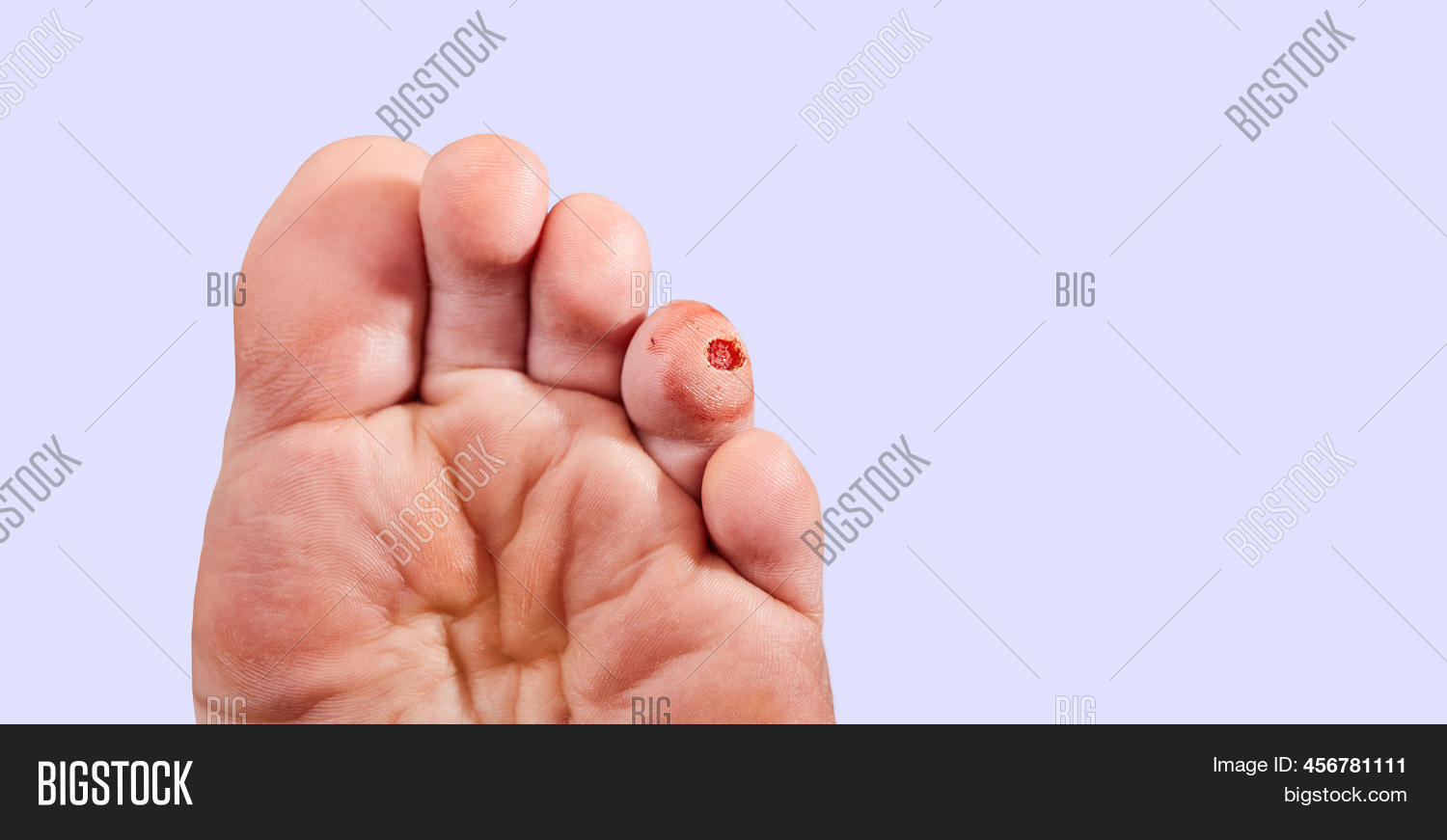Laser Removal Wart Toe Image & Photo (Free Trial) | Bigstock