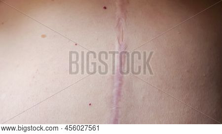 Surgery Scar On Female Belly Above Navel. Long Scar After Surgery On Female Abdomen. Postoperative S