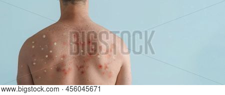 Male Back Affected By Blistering Rash Because Of Monkeypox Or Other Viral Infection On White Backgro