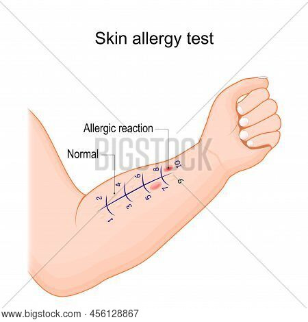 Skin Allergy Test. Human Arm With Small Amount Of The Allergen. Normal Reaction And Immune Response 