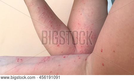 Monkey Pox Virus, A New World Problem Of Modern Humanity. Banner With Hands Of A Sick Person With Pi