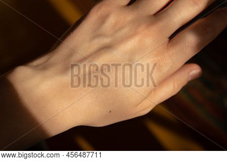 Birthmarks On Skin Close Up Detail Of The Bare Skin Sun Exposure Effect On Skin, Health Effects Of U