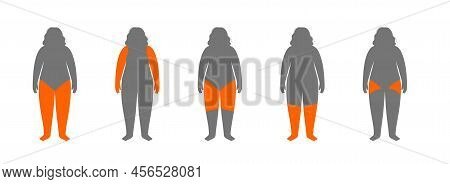 Lipedema And Overweight Disease Concept. Accumulating Fat In The Parts Of The Female Body. Cellulite