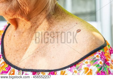 Skin Tag Or Acrochondon Or Soft Fibroma Is A Safe. It Have Not Effect To The Body. It Usually Occurs