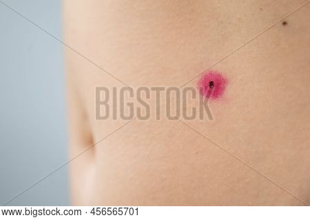 Close-up Of A Removed Wart On A Womans Abdomen. Human Papillomavirus After Burning.