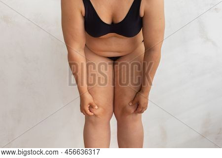 Cropped Overweight Woman With Dangling Belly, Excess Fat In Lingerie Squeeze Cellulite Folds Knees. 