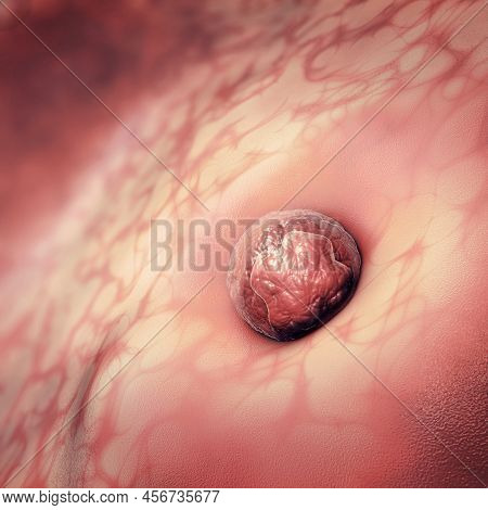 An Egg Cell Or Ovum Sticking To The Uterus - 3d Illustration