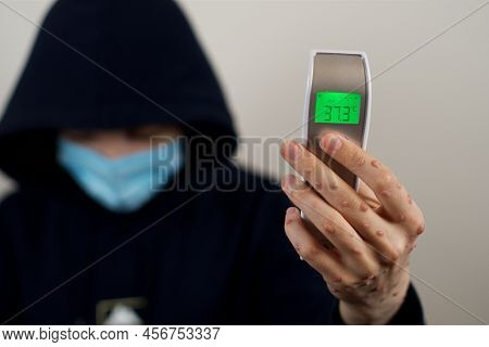 Infectred Person With Monkeypox Viral Rash Showing Termometer