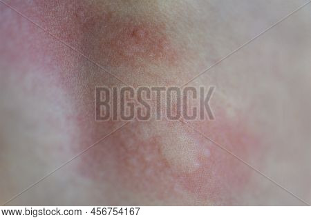 Urticaria On The Skin. Red Spots Of An Allergic Reaction On The Skin Of A Child. Urticaria Symptoms 