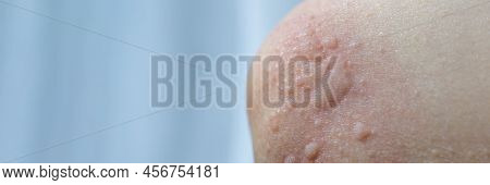 Urticaria On The Skin. Red Spots Of An Allergic Reaction On The Skin Of A Child. Urticaria Symptoms 