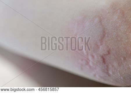 Urticaria On The Skin. Red Spots Of An Allergic Reaction On The Skin Of A Child. Urticaria Symptoms 