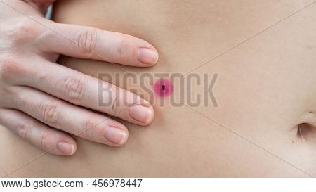 Close-up Of A Removed Wart On A Womans Abdomen. Human Papillomavirus After Burning.