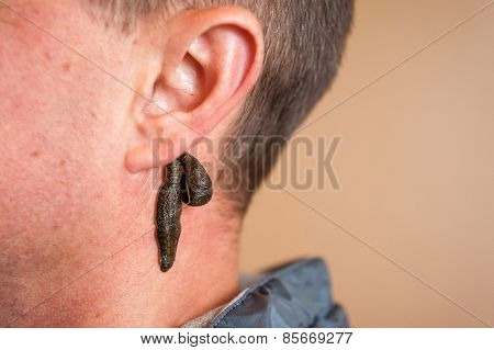 Leech Therapy For A Man