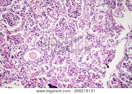 Lobar Pneumonia, Red Hepatic Phase, Light Micrograph, Photo Under Microscope
