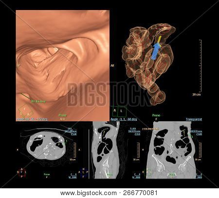 Ct Colonography Is Highly Sensitive For Colorectal Cancer, 3d Rendering Image Fron Ct Scanner.
