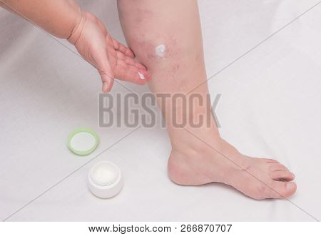 An Elderly Woman Applies Healing Ointment To Her Leg On Varicose Veins, Phlebeurysm Legs, Varicose, 