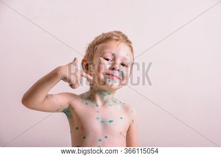 Young Toddler,boy With Chickenpox. Sick Child With Chickenpox. Varicella Virus Or Chickenpox Bubble