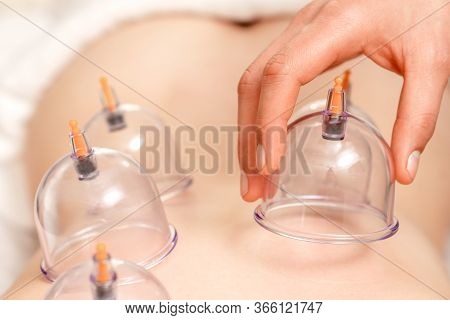 Hand Puts On Vacuum Cups Of Medical Cupping Therapy On Womans Back, Close Up, Chinese Medicine.
