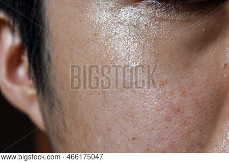 Excessive Sweating Or Hyperhidrosis At Face Of Southeast Asian, Myanmar Or Chinese Adult Young Man. 