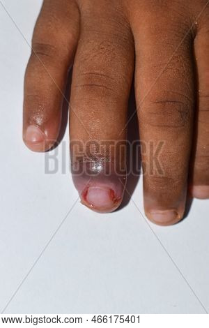 Paronychia In Asian Child. It Is Painful Lesion.