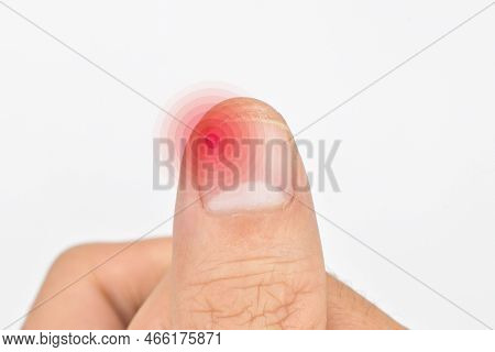 Inflammation At The Tip Of Fingernail. Concept Of Paronychia At Thumb Of Asian Young Man. Painful Fi