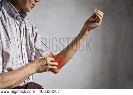 Asian Elder Man Scratching His Arm. Concept Of Itchy Skin Diseases Such As Scabies, Fungal Infection