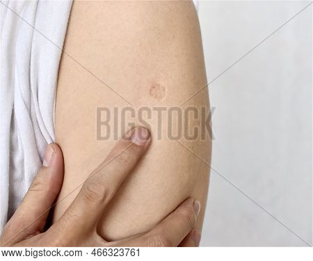 Bcg Or Tb Vaccine Scar Mark At The Arm Of Southeast Asian Man.
