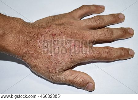 Itchy Skin Lesions In Hand Of Asian Adult Man. It May Be Caused By Scabies Infestation Or Fungal Inf