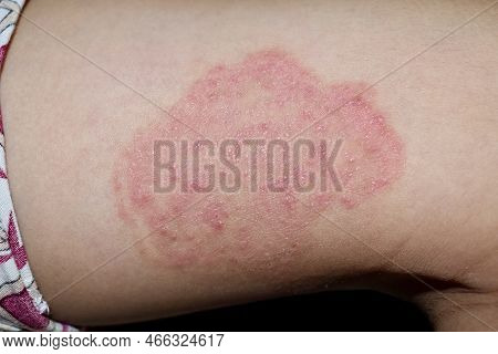 Fungal Infection Called Tinea Corporis In Thigh Of Southeast Asian Child. Ringworm