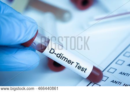 D-dimer Test To Look For Abnormalities From Blood,  Blood Sample To Analyze In The Laboratory, Blood