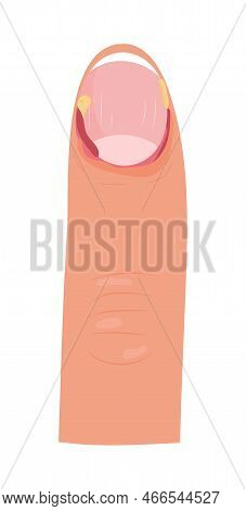 Paronychia Concepnt Vector For Medical Blog, App, Banner. Nail Inflammation That May Result From Tra