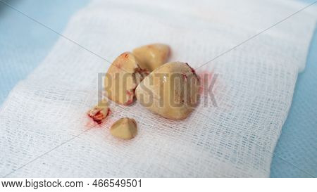 On A White Napkin Are Stones From The Bladder Removed By The Operation Of Cystolithotomy. The Format