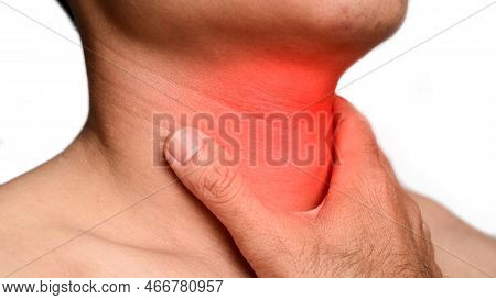Redness At Neck Of Asian, Myanmar Man. Concept Of Sore Throat, Pharyngitis, Laryngitis Or Dysphagia.
