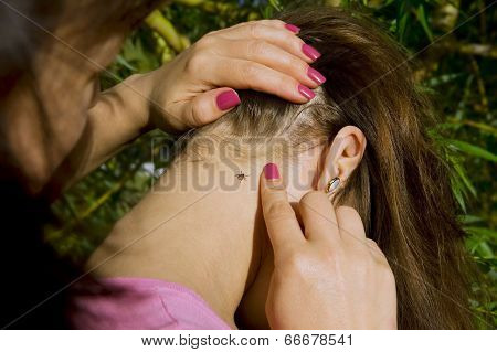 People Looking At Wood Tick Embedded In Human Skin