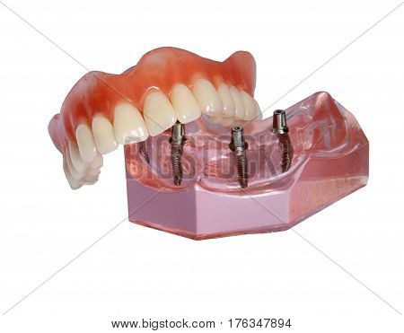 Denture lies on model of top tooth jaw with implants isolated on white background