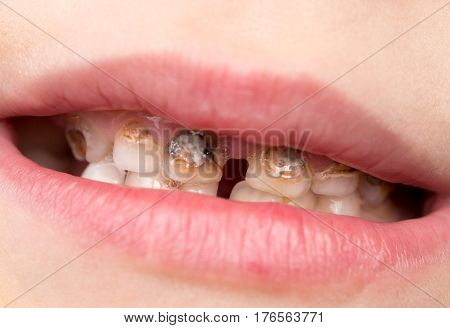 Dental medicine and healthcare - human patient open mouth showing caries teeth decay .