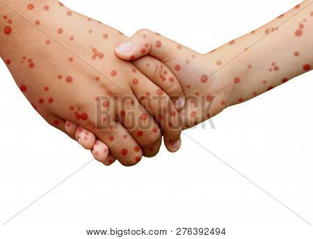 Measles Disease Concept And Viral Illness As A Contagious Chickenpox Or A Skin Rash.