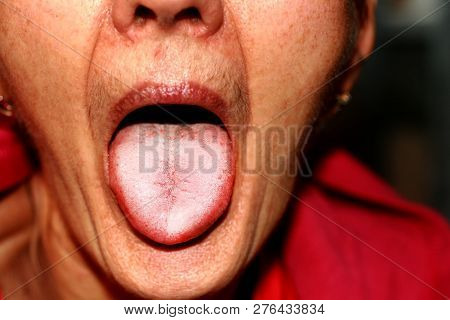 The Tongue Is In A White Raid. Candidiasis In The Tongue