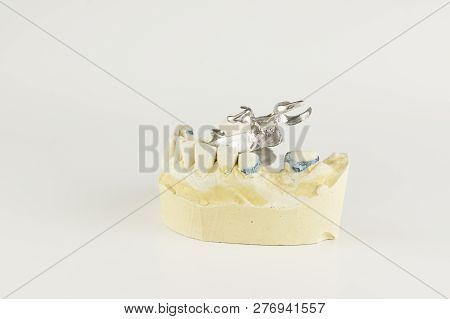 Steel Base Of The Clasp Prosthesis On The Gypsum Model