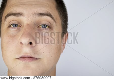 The Yellow Color Of The Male Eye. Symptom Of Jaundice, Hepatitis Or Problems With The Gall Bladder,